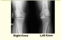 Virtual Knee Surgery